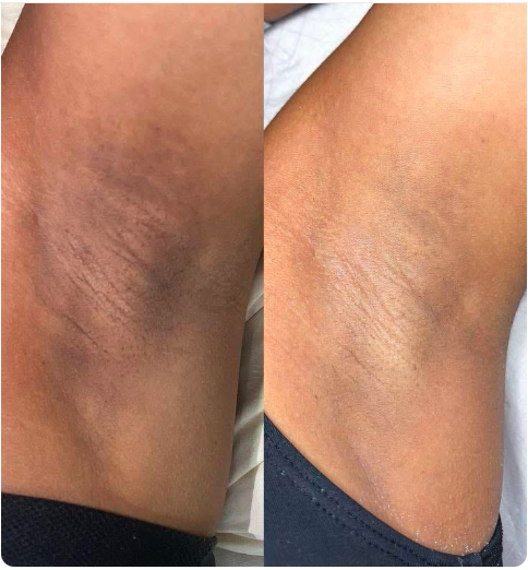 Retrouvez peau éclatante instantanément avec notre gel exfoliant