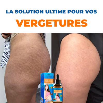 Eliminez vos vergetures en seulement 14 jours